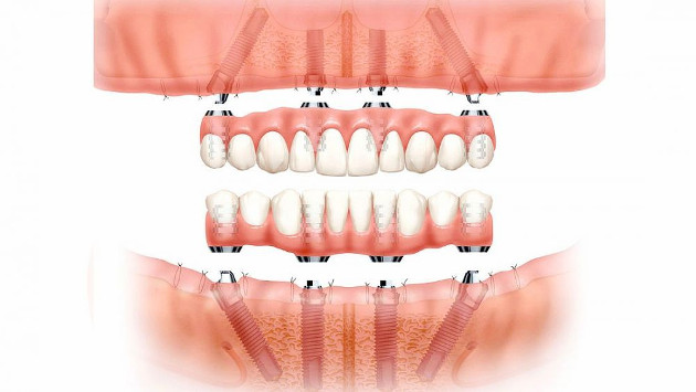 Bedančių žandikaulių dantų implantavimas VISI ANT 4 metodu