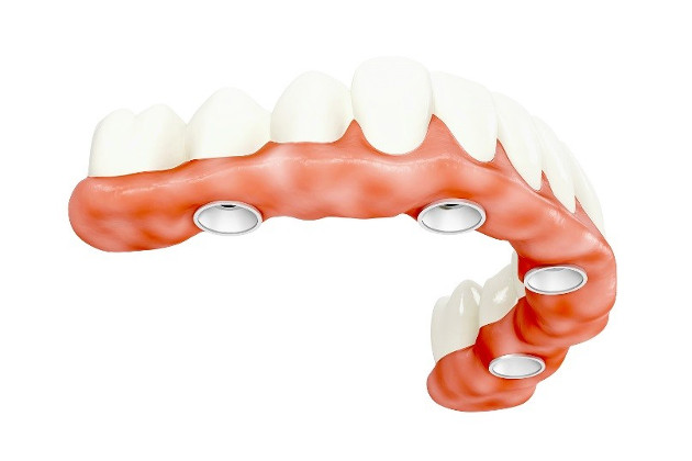 Bedančių žandikaulių dantų implantavimas VISI ANT 4 metodu