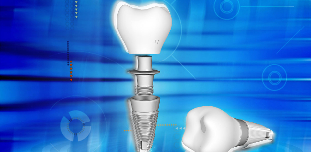 Dantų implantai – sveikų ir baltų dantų garantija