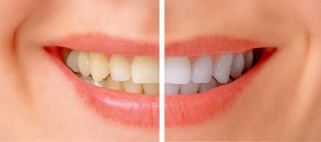 Profesionali dantų higiena – kad šypsenos netemdytų pakitusi dantų spalva