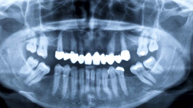 Protiniai dantys – šalinti ar palikti ramybėje?