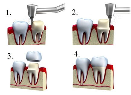 Dantų protezavimas – inovatyvi technologija, kurios dėka atkuriami prarasti dantys