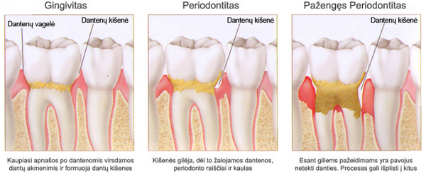 periodontitas-porodontoze