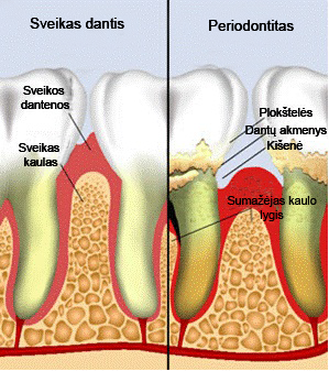 periodontito-pasekmes