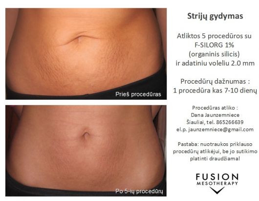 Procedūros odos defektams gydyti su FUSION MESOTHERAPY® – prieš ir po