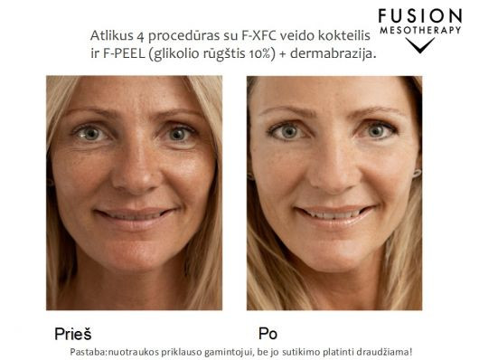 Procedūros odos defektams gydyti su FUSION MESOTHERAPY® – prieš ir po