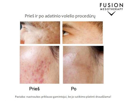 Procedūros odos defektams gydyti su FUSION MESOTHERAPY® – prieš ir po