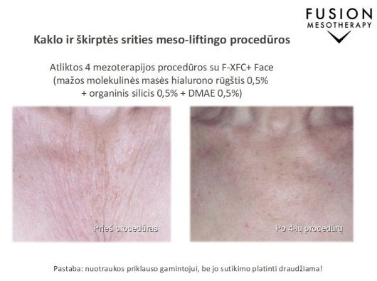 Procedūros odos defektams gydyti su FUSION MESOTHERAPY® – prieš ir po