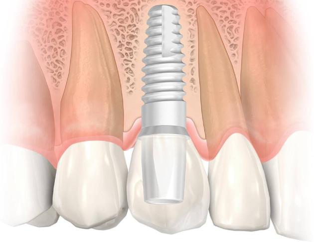 Bemetalis cirkonio implantas