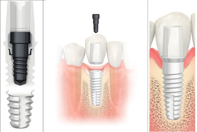 Bemetalis cirkonio implantas