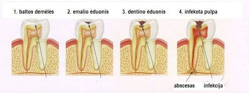 Dantų ėduonies atsiradimo priežastys ir prevencija 