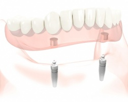 Dantų protezai praradusiems visus dantis - All-On-4
