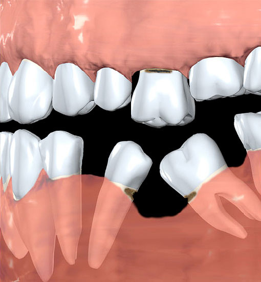 Dantų rovimas ir atkūrimas: ar visada geriau rauti, nei taisyti?