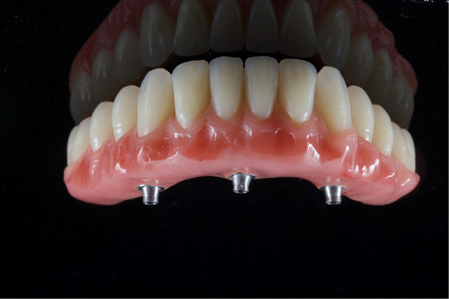 Dantų implantavimo sistema TREFOIL