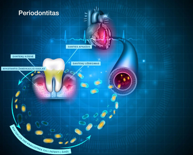 Endodontinis gydymas