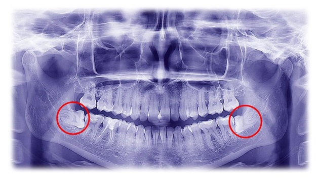 Protiniai dantys – šalinti ar palikti ramybėje?