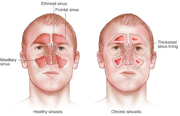 Kas yra sinusitas?