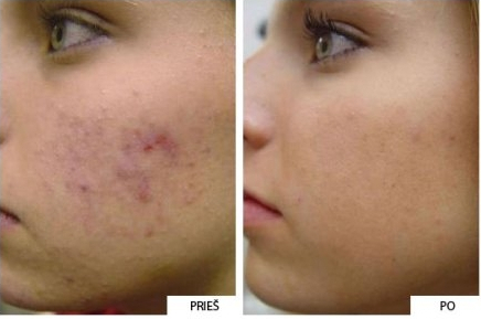 Efektyvus aknės ir kuperozės gydymas bei pigmentinių dėmių šalinimas intensyvios pulsinės šviesos aparatu Trios™