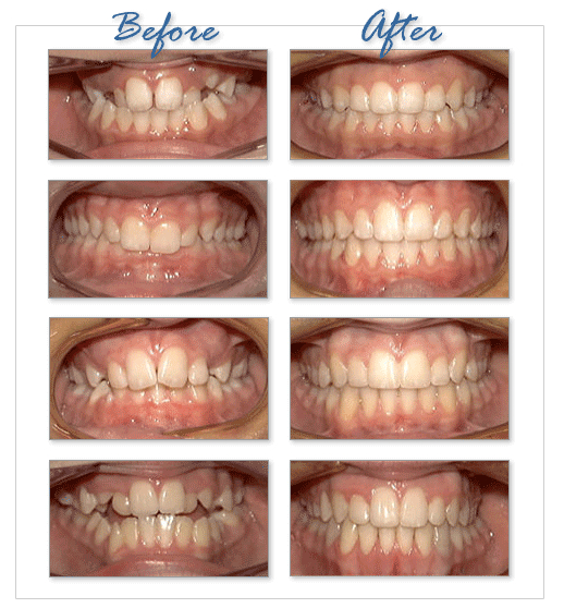 Ortodontinis gydymas - kreivai išdygusiems dantims ištiesinti, netaisyklingo sukandimo gydymui, bei veido-žandikaulių sistemos vystymosi sutrikimų korekcijai