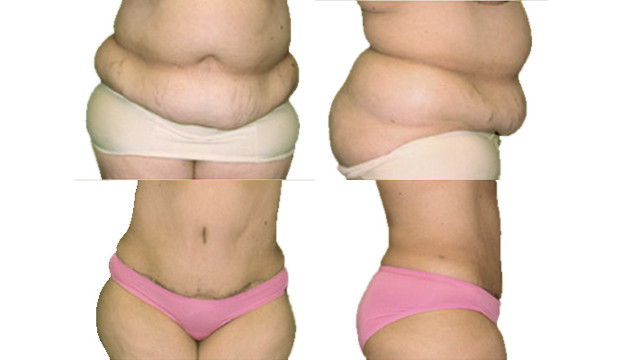 Pilvo sienelės plastika (abdominoplastika)