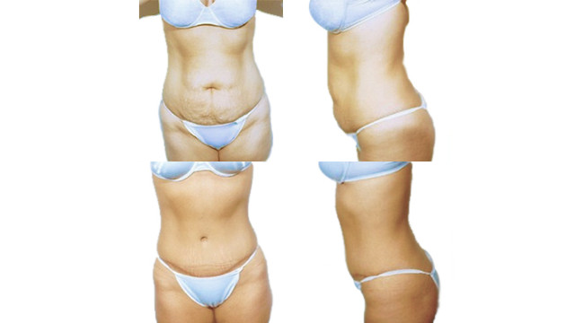 Pilvo sienelės plastika (abdominoplastika)