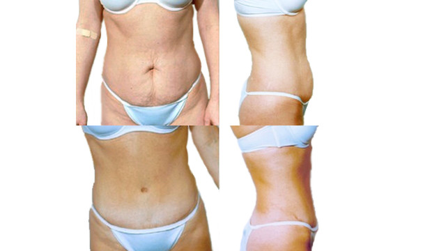 Pilvo sienelės plastika (abdominoplastika)