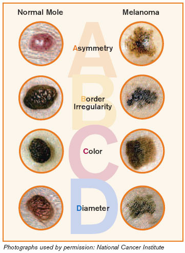 Melanoma  -  tyli, bet grėsminga odos liga