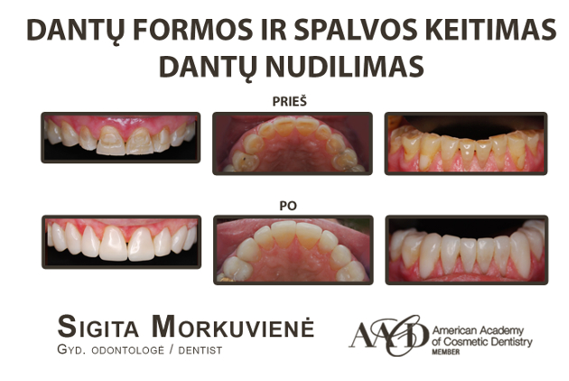 Estetinis plombavimas estetinės odontologijos klinikoje ProDentas