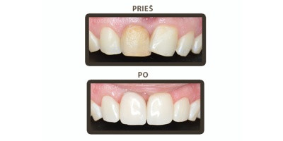 Estetinis plombavimas – dantys bus gražūs ir sveiki