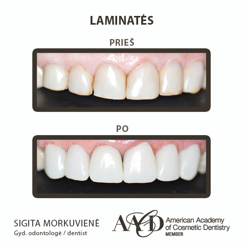 Porceliano laminatės – alternatyva estetiniam plombavimui