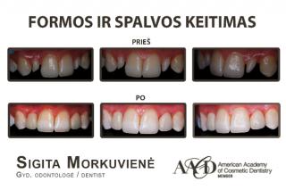 PRODENTAS – odontologijos klinika Kaune nuo 1999 m. Dantų gydymas, implantacija, protezavimas
