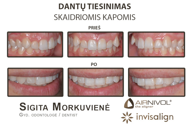 AlfaDenta, UAB - visos estetinės odontologijos paslaugos Kaune: dantų gydymas, estetinis plombavimas, greitasis dantų tiesinimas