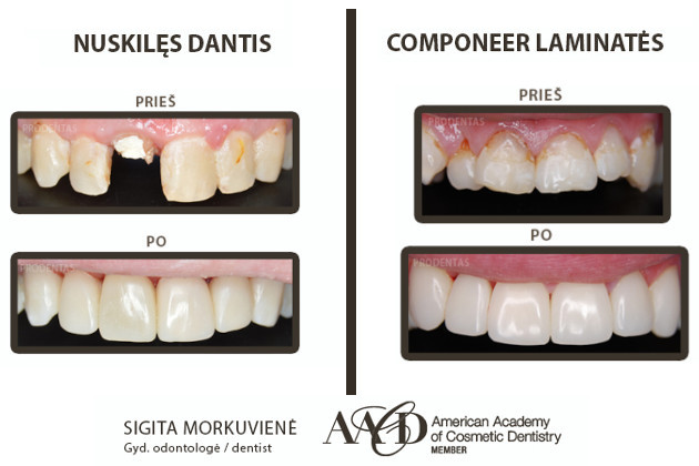 AlfaDenta, UAB - visos estetinės odontologijos paslaugos Kaune: dantų gydymas, estetinis plombavimas, greitasis dantų tiesinimas