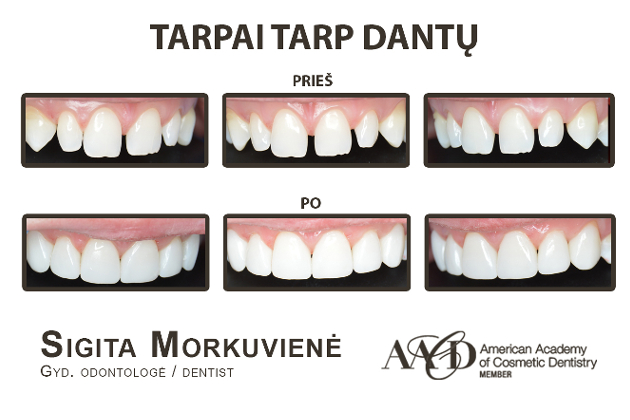 AlfaDenta, UAB - visos estetinės odontologijos paslaugos Kaune: dantų gydymas, estetinis plombavimas, greitasis dantų tiesinimas