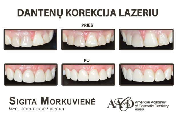 AlfaDenta, UAB - visos estetinės odontologijos paslaugos Kaune: dantų gydymas, estetinis plombavimas, greitasis dantų tiesinimas
