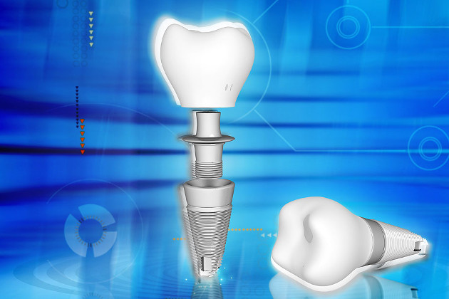 ANGITIA, UAB, odontologijos klinika. Dantų implantavimas, protezavimas ir visos odontologo (stomatologo) paslaugos