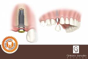 Dantų implantacija: Kodėl verta pasirinkti protezavimą dantų implantais?