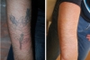 Tatuiruočių šalinimas: MODUS studija tai atlieka greitai ir neskausmingai