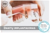Dantų implantavimas - greitas ir neskausmingas sprendimas